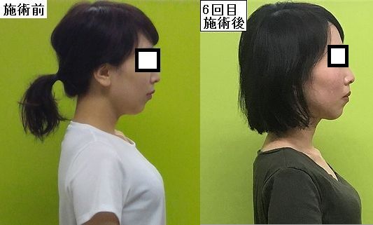 アンドリューハリディ ムスタチオ 心配 猫背 顔 むくみ Escalier15 Com