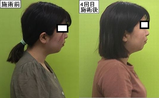 寒暖差でお顔パンパンにむくんでませんか 春が来る前に小顔施術でスッキリフェイス取り戻しませんか 津山市の小顔整体 津山市の産後骨盤矯正 猫背矯正 作楽整体院 公式ブログ