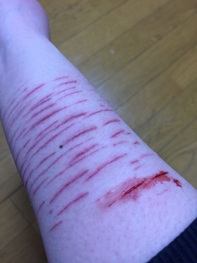 切ったあと あたしの居場所 リストカット時どき写真