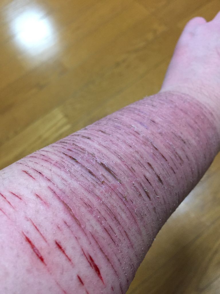 切ったあと あたしの居場所 リストカット時どき写真