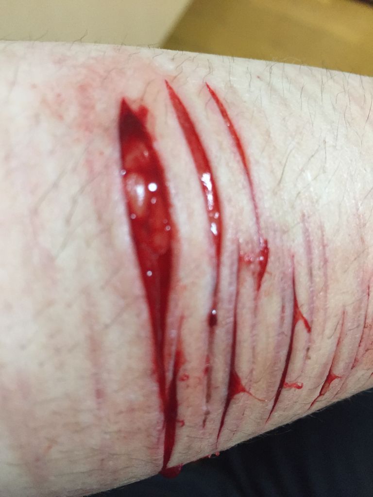 深く切られた左腕 あたしの居場所 リストカット時どき写真