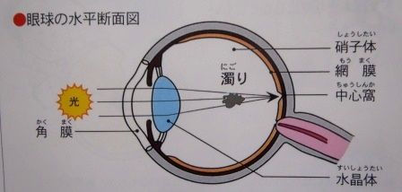 飛蚊症