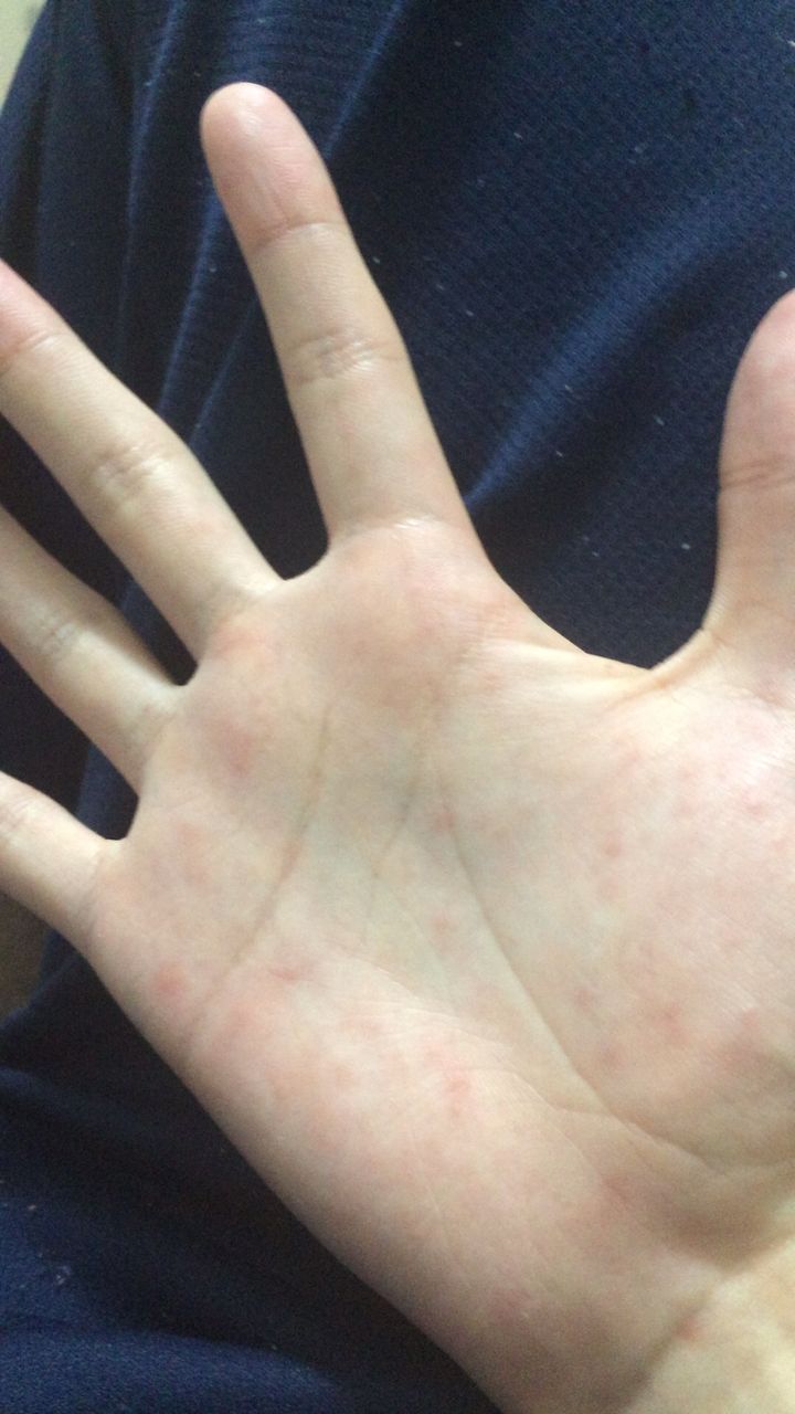手のひらにブツブツがいっぱいできたンゴ 画像あり 三度の飯よりご飯 手のひらにブツブツがいっぱいできたンゴ 画像あり 三度の飯よりご飯