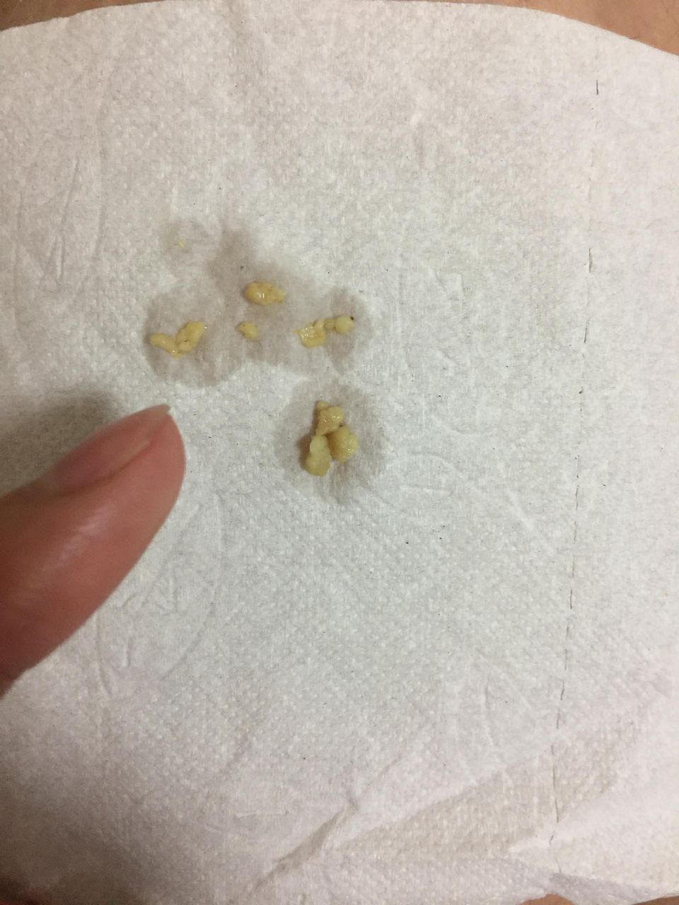 閲覧注意 臭い玉が大量に取れたったwww 画像あり 三度の飯よりご飯