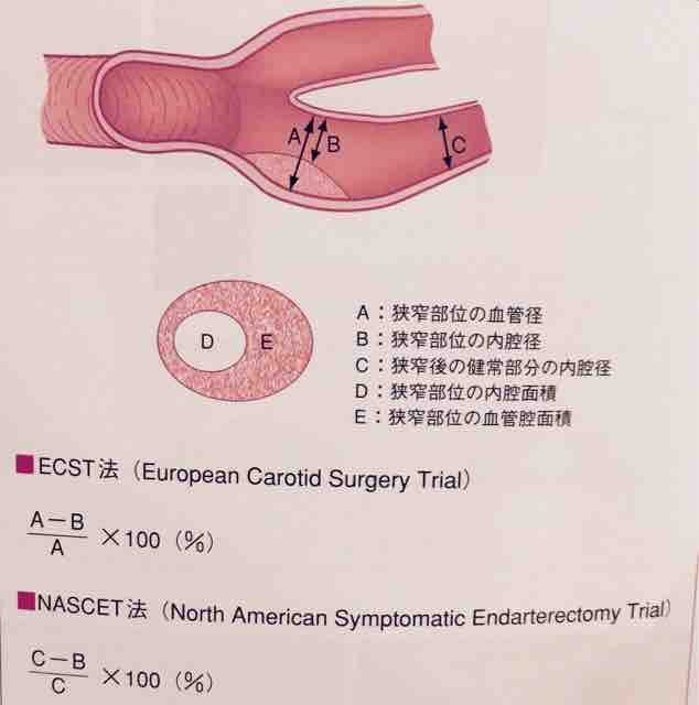 頸動脈狭窄症 川崎仁志の神経内科ブログ