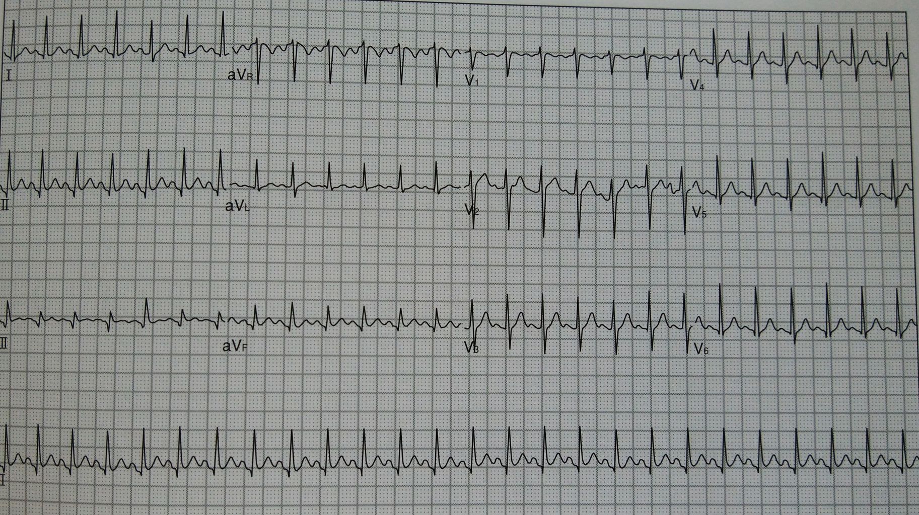 波形の特徴を覚えよう 洞頻脈 心電図の部屋