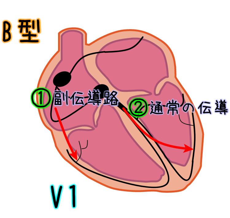 12誘導心電図を読んでみよう 61歳男性 動悸 心電図の部屋