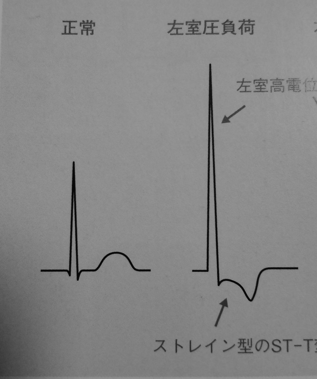 波形の特徴を覚えよう 左室肥大 心電図の部屋