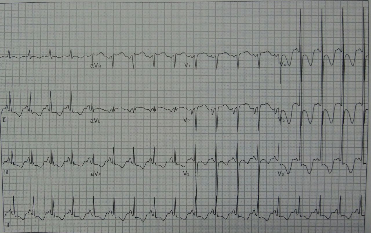 12誘導心電図を読んでみよう 54歳女性 転倒後の意識レベル低下 心電図の部屋