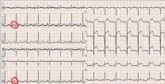 波形の特徴を覚えよう 右房負荷 心電図の部屋