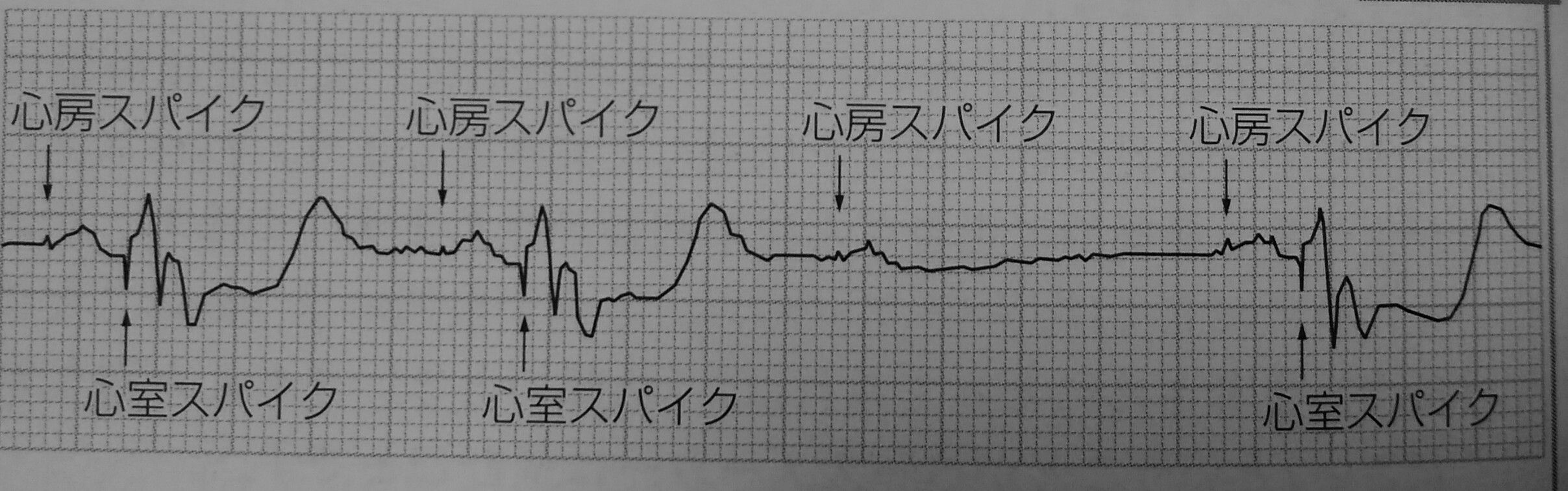 ペースメーカー不全 クロストーク 心電図の部屋