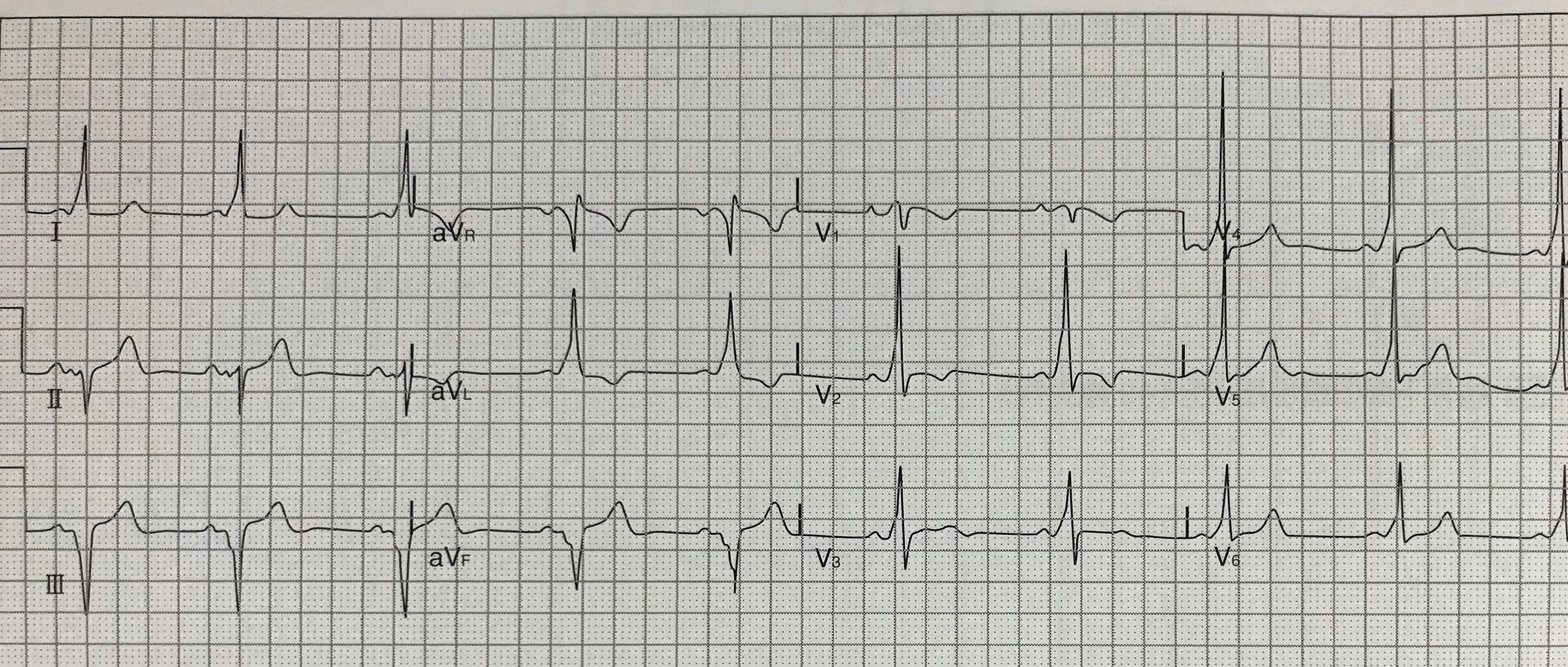 心電図 12誘導 位置>心臓 絵 心臓 イラスト 簡単 イラスト画像集