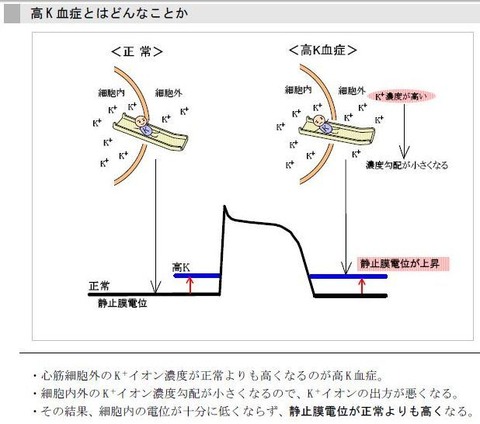 高カリウム血症