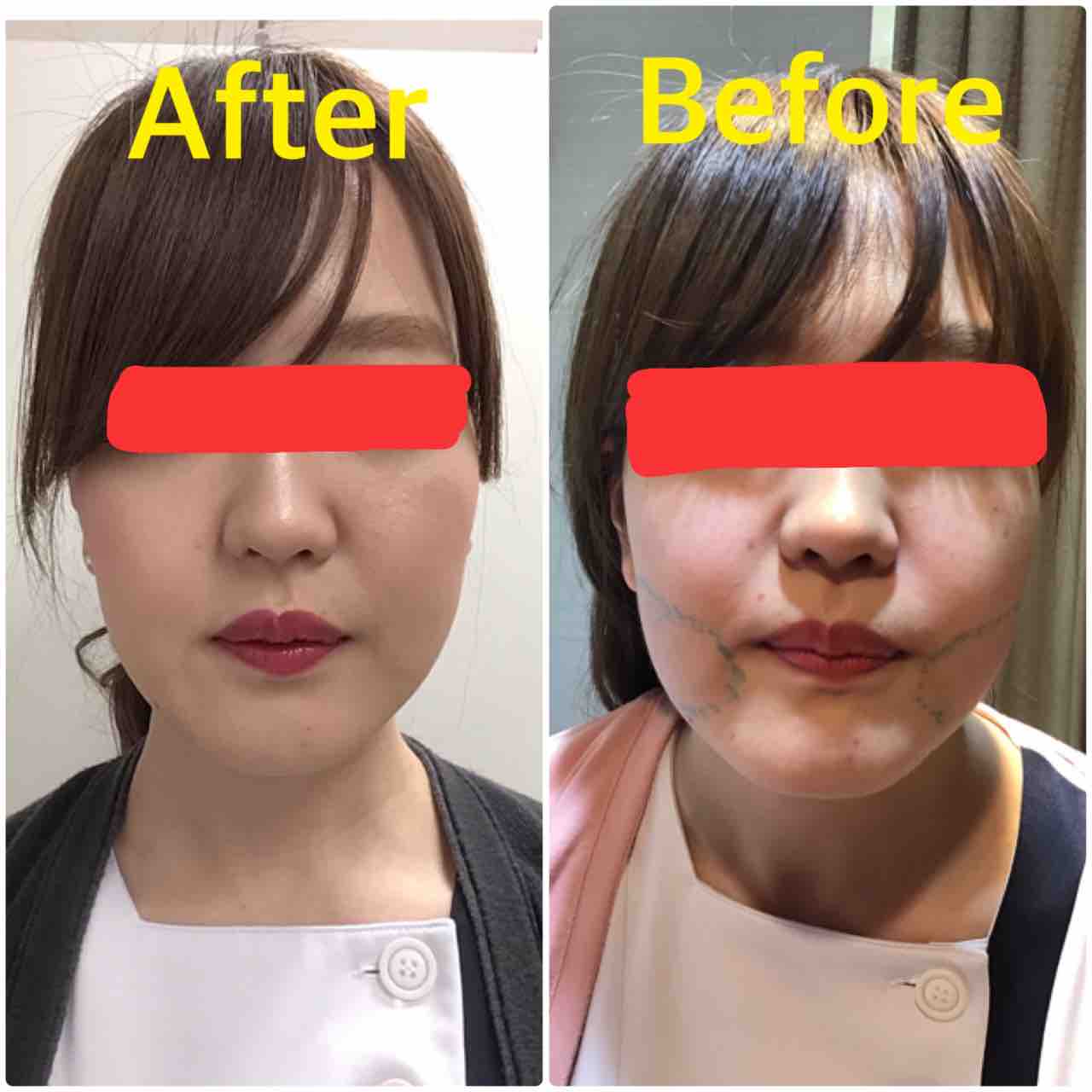 大人気の脂肪溶解注射 渋谷美容皮膚科クリニックのブログ 大人気の脂肪溶解注射 渋谷美容皮膚科クリニックのブログ