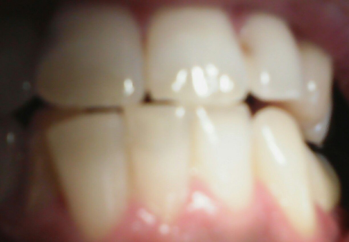 ホワイトニング歯磨き 35日目 ホワイトニング 白い歯 ホワイトニング歯磨きジェル ブラニカで実践
