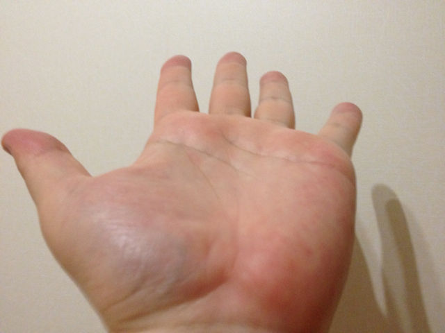 肝臓が悪いと手のひらが 原付二種スクーター 日記の部