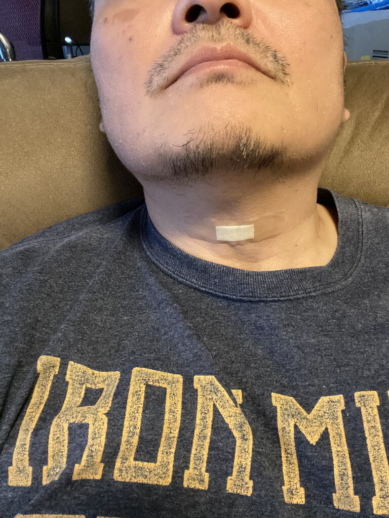 声帯萎縮の手術をした ダーツマニアックス Darts Maniax 声帯萎縮の手術をした ダーツマニアックス Darts Maniax