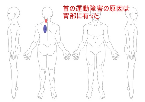 首の運動障害の原因は背部に有った