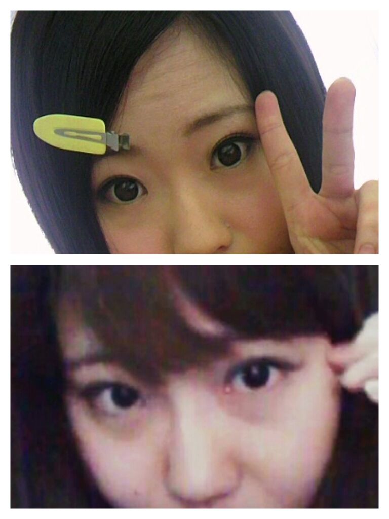 目頭切開比較画像 整形してもブスはブス