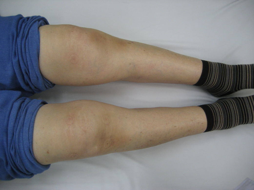 膝関節伸展不全が誘因となる膝関節捻挫 整骨太郎のひとりごと
