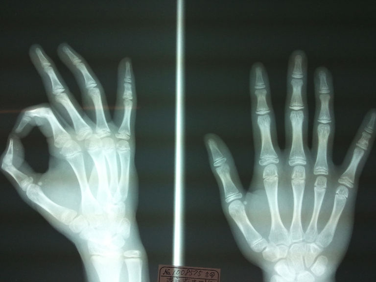 女子バスケで指骨折 痛い 豊川市の田口接骨院 整骨院