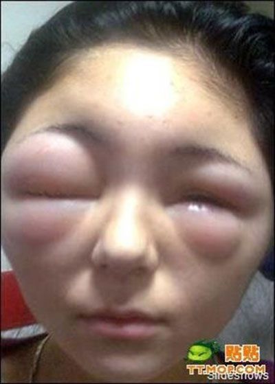 B ハチに刺された結果wwwwwwwwwwwwwwwwwwwwwww 画像 世界の憂鬱 海外 韓国の反応 B ハチに刺された結果wwwwwwwwwwwwwwwwwwwwwww 画像 世界の憂鬱 海外 韓国の反応