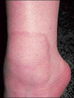 お医者になるのは 大変ですね 環状肉芽腫 お医者になるのは 大変ですね 環状肉芽腫