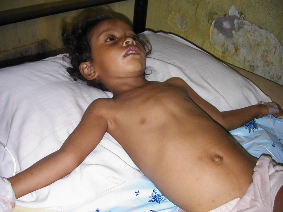 #5 In 2007 Dili a boy with two malaria
