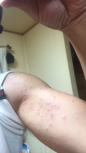 毛虫に刺される しげおの部屋