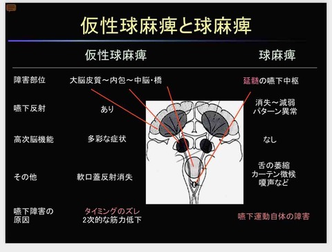 仮性球麻痺と球麻痺 : 毎日の勉強記録