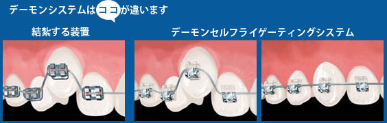 最新の矯正治療 デーモンシステム