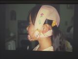 反対咬合(受け口)の矯正治療 チンキャップ