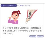 インプラント 口腔ケア 摂食治療