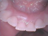 子供の歯並び・歯列育形成・床矯正・子供の歯列矯正・小児矯正