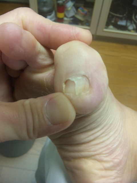爪の下から爪が生えて来ました 崖っぷちのトニョ 糖尿 ギニオン 膵臓がんと闘う 爪の下から爪が生えて来ました 崖っぷちのトニョ 糖尿 ギニオン 膵臓がんと闘う