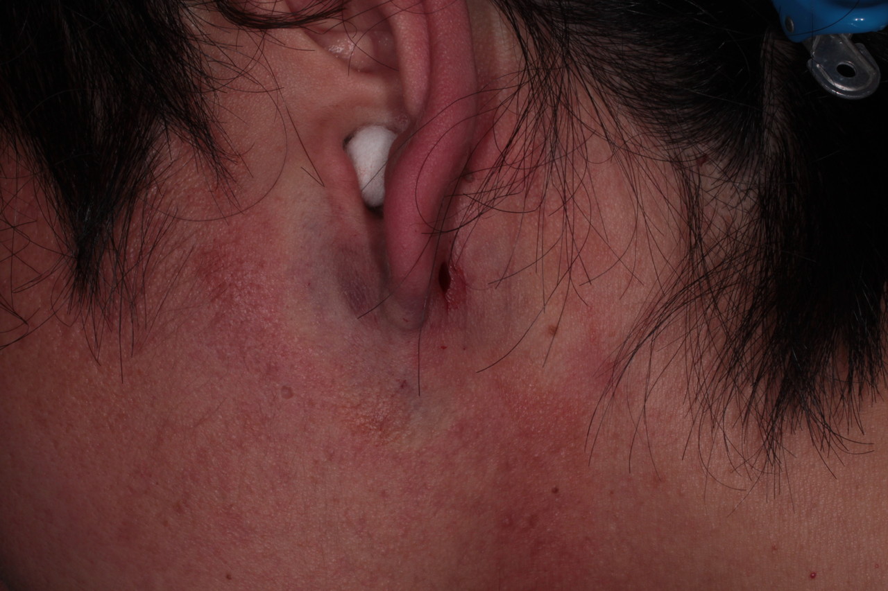 珍しい粉瘤 新潟市の皮膚科医のブログ