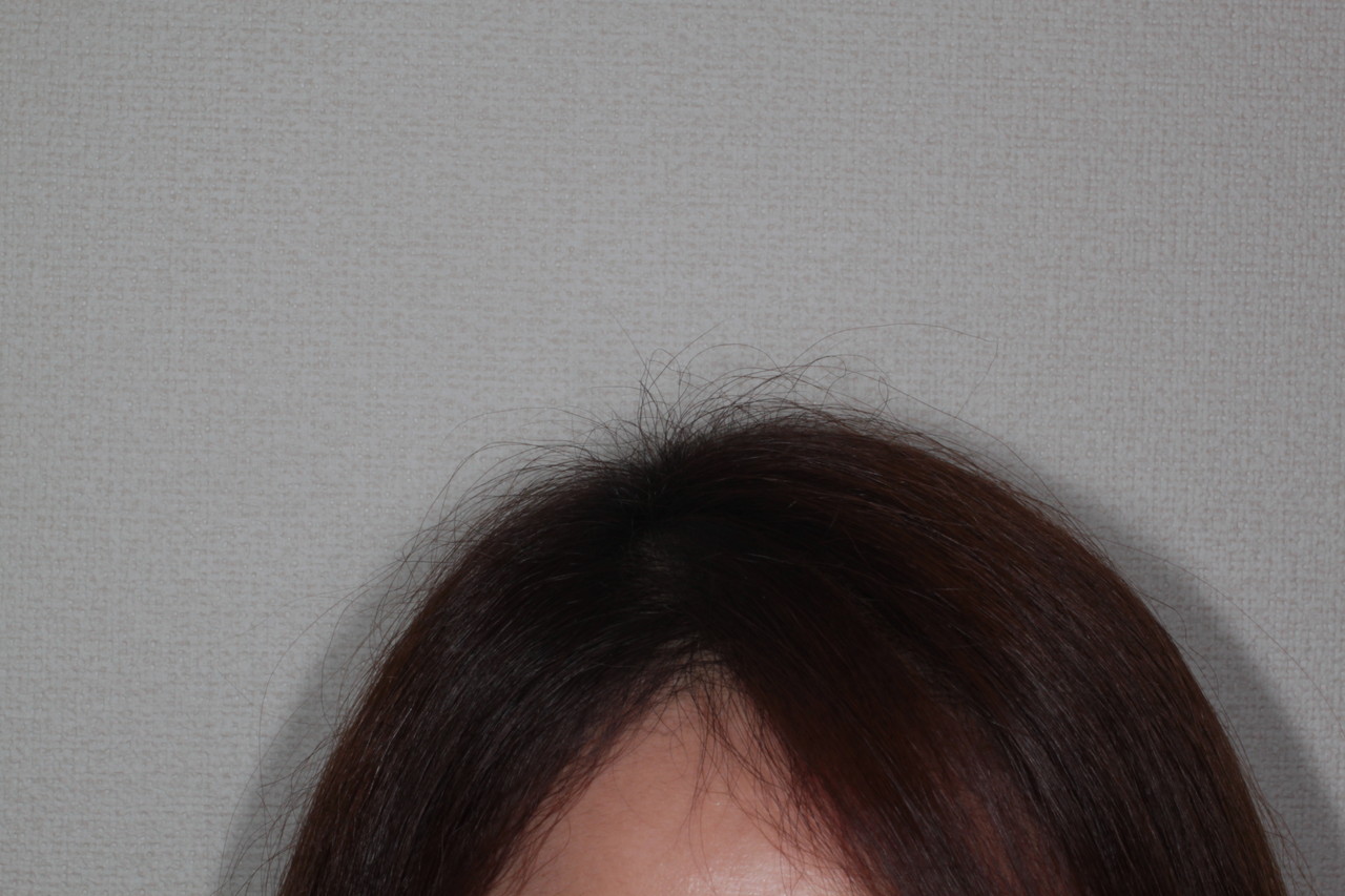 女性の薄毛 新潟市の皮膚科医のブログ