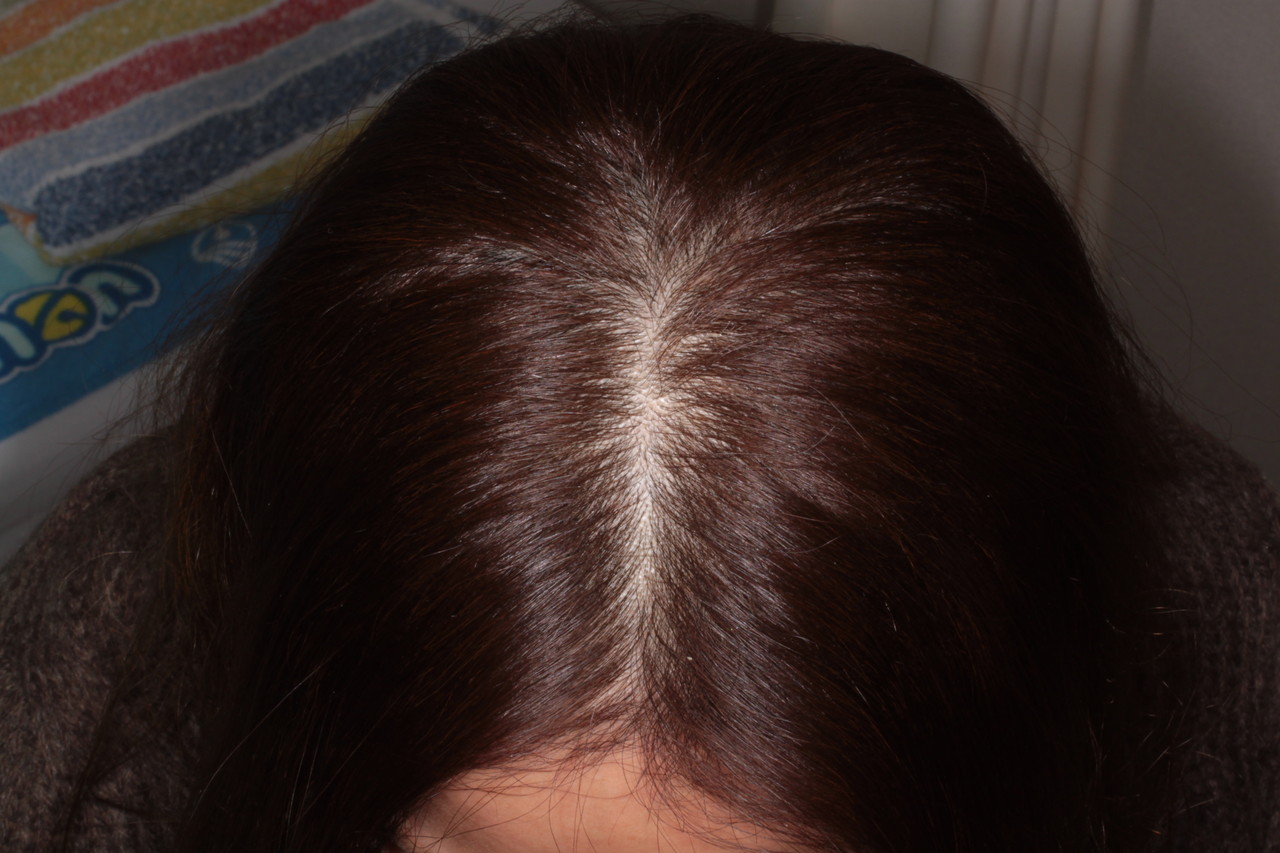 女性の薄毛の治療 新潟市の皮膚科医のブログ