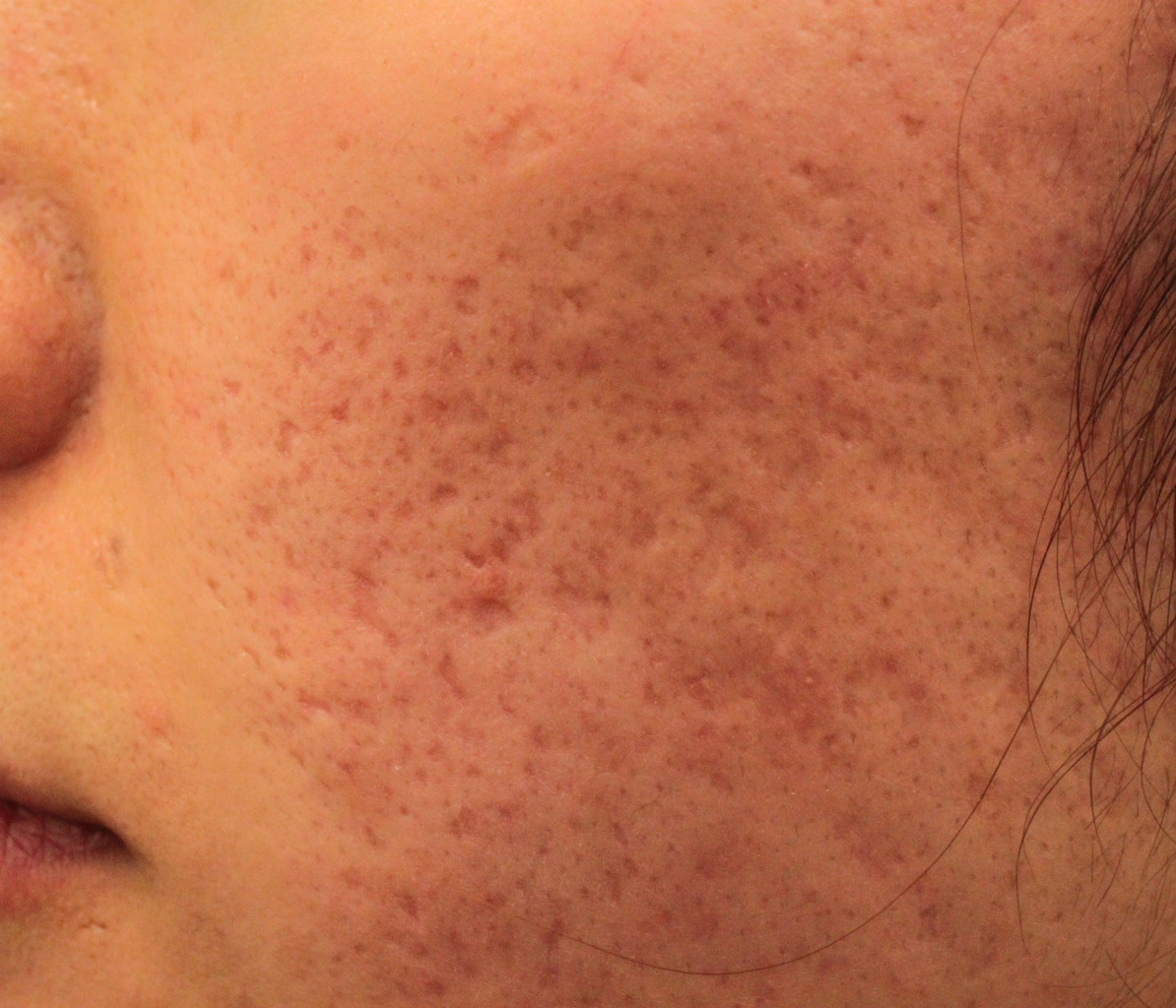 ニキビ跡のフラクショナル炭酸ガスレーザー治療 新潟市の皮膚科医のブログ