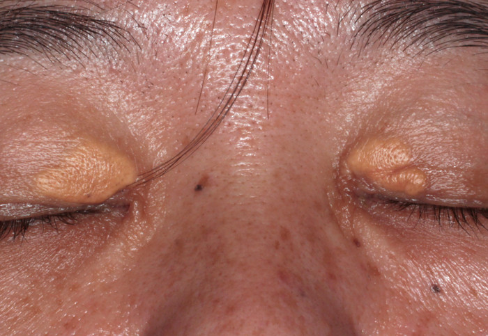 眼瞼黄色腫の色素レーザー治療 新潟市の皮膚科医のブログ