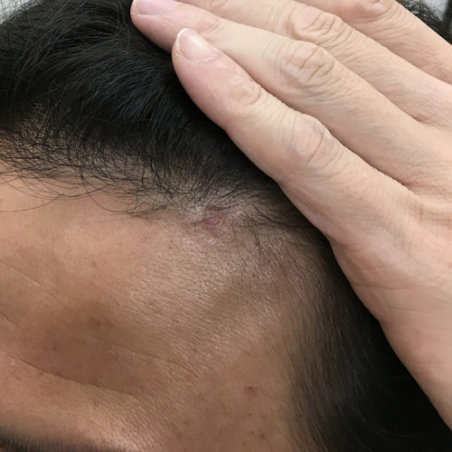 老人性イボの治療 新潟市の皮膚科医のブログ