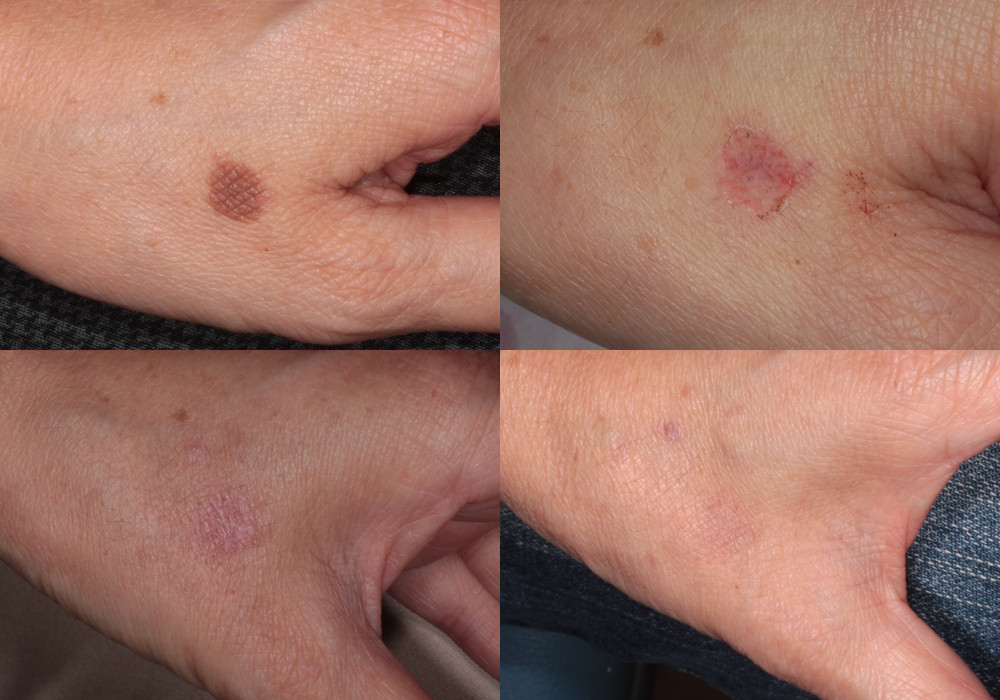 手のシミ 脂漏性角化症 新潟市の皮膚科医のブログ