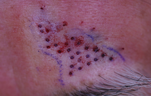 白斑のミニグラフト法 ミニ植皮術 新潟市の皮膚科医のブログ