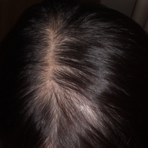女性の薄毛のミノキシジル内服治療 新潟市の皮膚科医のブログ