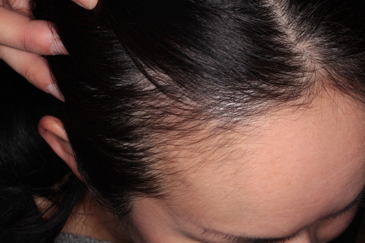 女性の薄毛モニター途中経過 新潟市の皮膚科医のブログ