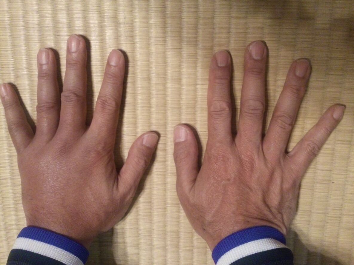 骨折ではないはずだけど 走る 旦那の マラソン道