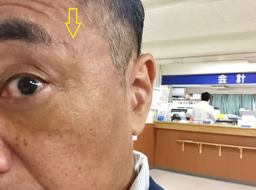 抜糸