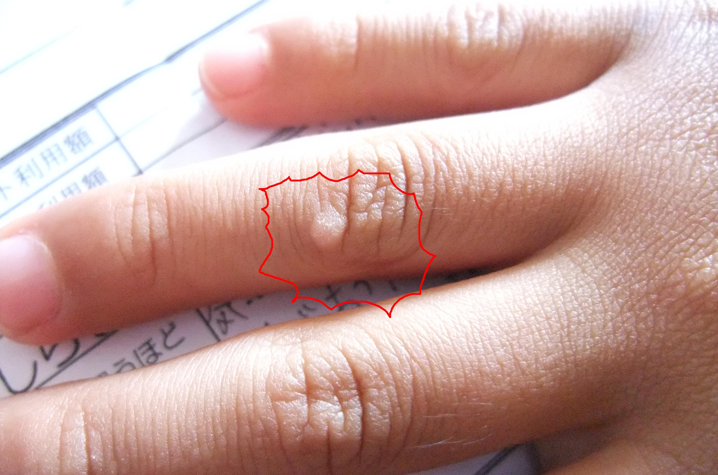 優輝のイボ治療２ 囲炉裏を囲んで座談会