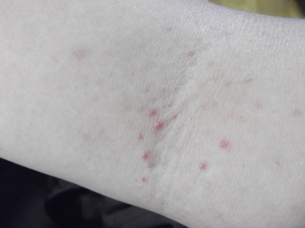 腕に謎の発疹が 再び 大人の発達障害と向き合う静葉ちゃんの試験室