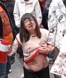 脂肪吸引 事故 失敗